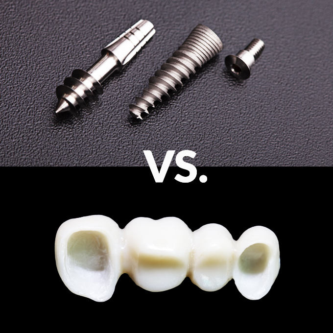 Implants vs. Bridges